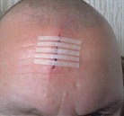 HypaCover Skin Closure Strips